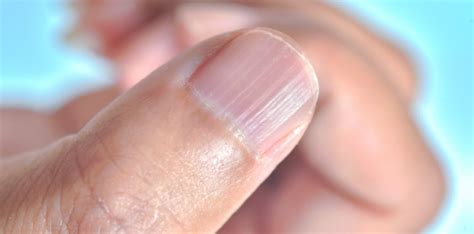阿波羅花 指甲有橫紋